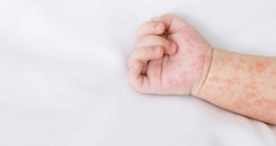 سرخک به طور هشدارآمیزی در اروپا در حال پیشروی است